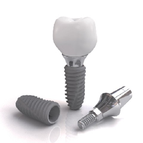 LỢI ÍCH KHI CẤY GHÉP IMPLANT NHA KHOA CÙNG DENTIUM